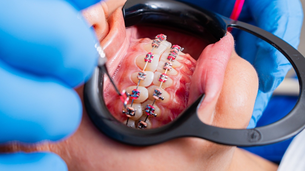 Braces & Clear Aligners (Invisalign)