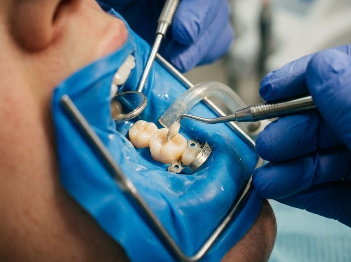 Composite Fillings